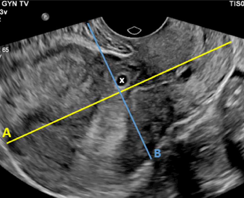 Accuracy of first trimester sonographic features in diagnosing caesarean scar pregnancy